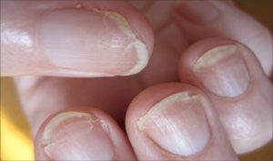پیشگیری از ترک خوردن ناخن