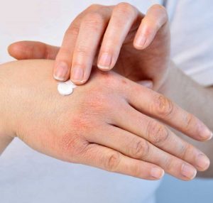 پوست خشک و زمستان