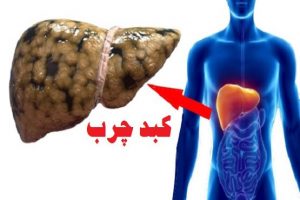 چند توصیه کاربردی جهت پیشگیری از کبد چرب
