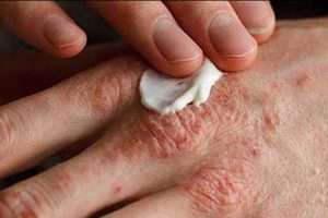 بهترین راهکارها برای تسکین علائم اگزما