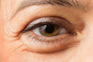 علت پف کردن چشم ها چیست؟