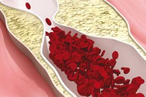 فرمول های طبیعی و دارویی کاهش چربی خون