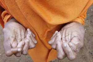 انگشتان زیاد دست و پای زن هندی! + تصاویر