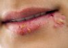 علت تبخال چیست؟