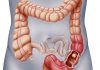 راهی جدید برای درمان سرطان روده