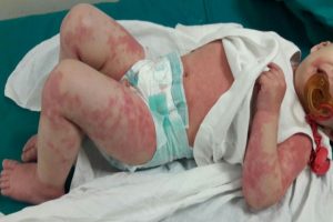 بیماری کاوازاکی را با این اعلام بشناسید / عارضه ای شبیه روماتیسم