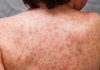 ارتباط سندروم التهابی کاوازاکی و ویروس کرونا؛ شواهد چه می گویند؟