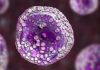 روش درمانی جدید برای یکی از انواع نادر سرطان خون