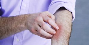 بیماری پوستی پسوریازیس چیست و آیا درمانی دارد؟