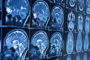 کاهش ۳۰ درصدی عوارض سکته مغزی با تشخیص زودهنگام
