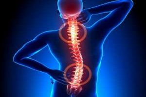 سیاتیک، شایع ترین علت کمردرد بین ایرانی هاست