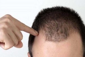 راههایی برای جلوگیری از ریزش مو در آقایان