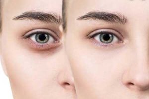 راهکارهای طبیعی برای برطرف کردن تیرگی دور چشم
