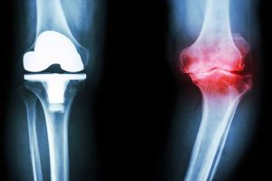 گیاهی جادویی برای تسکین درد آرتروز زانو