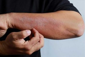 علائم و انواع حساسیت پوستی کدامند؟