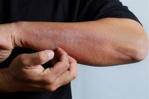 خارش کرونایی؛ عارضه عذاب آور برای بهبود یافتگان
