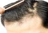 برای جلوگیری از ریزش مو چه کنیم؟