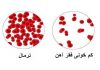 آشنایی با شایع ترین علائم کم خونی