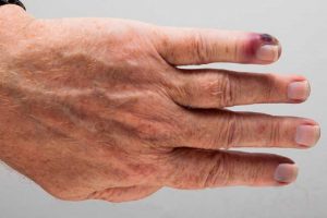 بیماری مرگبار سپسیس چیست؟