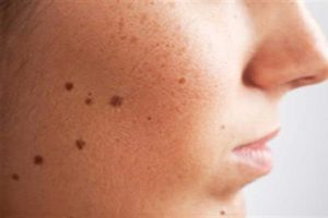 درمان های خانگی برای از بین بردن خال های مزاحم