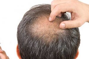 تفاوت ضایعات پوستی ناشی از کرونا با سایر عوارض پوستی