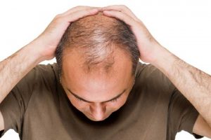 نوشیدنی محبوبی که جلوی طاسی را می‌گیرد