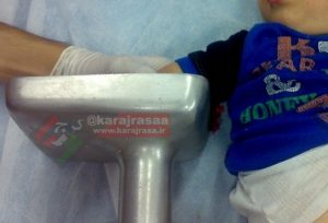 چرخ گوشت انگشتان کودک ۶ ساله فردیسی را بلعید