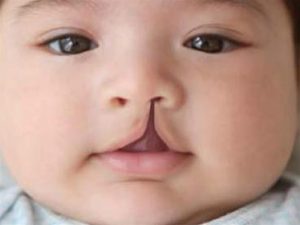 فعالیت کلینیک شکاف کام و لب در مجتمع آموزشی و درمانی امام علی (ع)