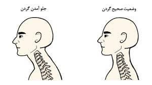 ناهنجاری سر به جلو، علل، علائم و برخی تمرینات مربوط به آن