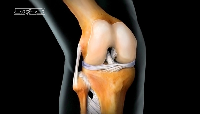 عمل تعویض مفصل زانو رایگان انجام می شود