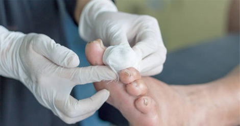 درمان رایگان زخم پای دیابتی در کرج